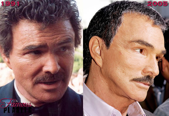 Burt Reynolds Facelift